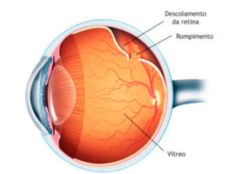 Deslocamento De Retina Dr Guilherme Correa